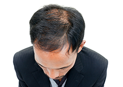 Young man who is prematurely balding who needs hair loss treatment