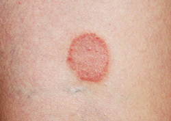 Online Ringworm Treatment - Virtual Doctor - MD Anywhere
