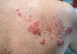 Shingles (herpes zoster, varicella-zoster) skin rash and blisters on the upper back