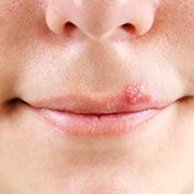 close up of mouth with a cold sore