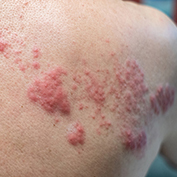 Shingles (herpes zoster, varicella-zoster) skin rash and blisters on the upper back