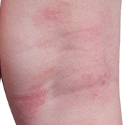 Eczema on skin of an extremity